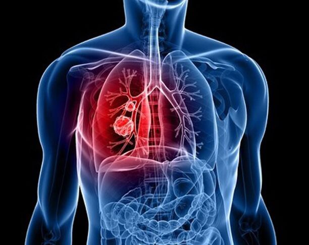 Parasiten in der Lunge.